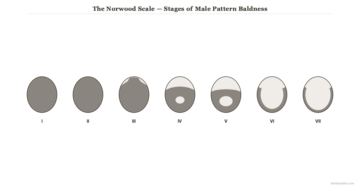 Male Pattern Baldness: The Complete Guide to Androgenetic Alopecia