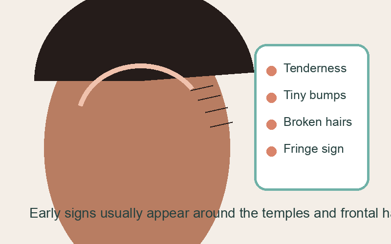 Illustrated diagram of the frontal hairline showing early traction alopecia warning signs: perifollicular erythema, small bumps, the fringe sign, and the temporal recession zone