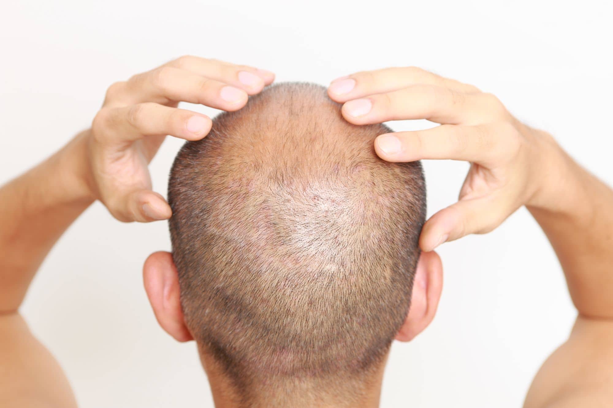 Treating Baldness and Thin Hair with Scalp Med | Hairlossable